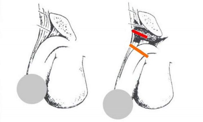 Penis enlargement ligament incision