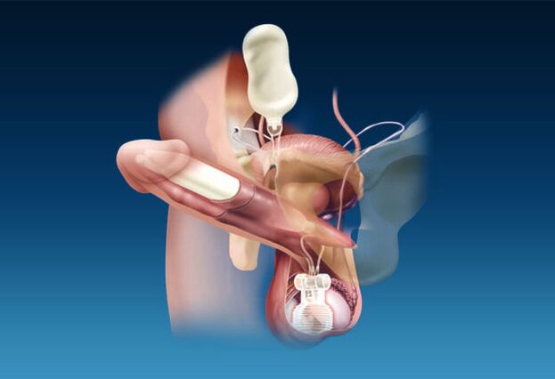 Enlarged penile implants